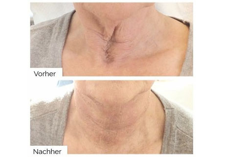 Hals vor und nach der Plasma Behandlung