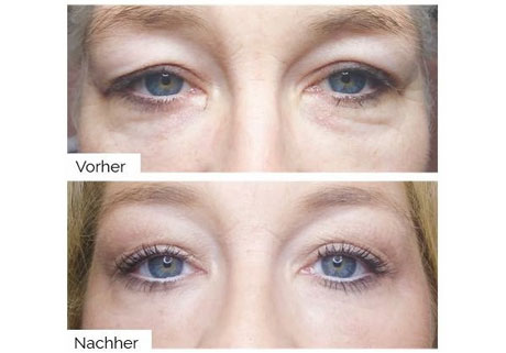 Augen vor und nach der Plasma Behandlung