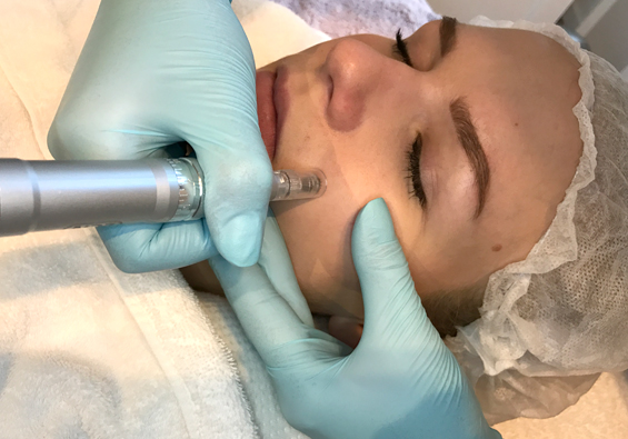 Micro Needling Behandlung